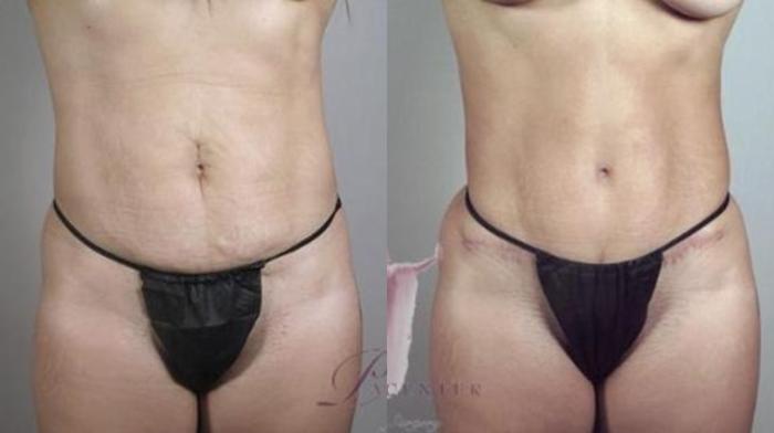 Tummy Tuck Case 1130 Before & After Front | Paramus, New Jersey | Parker Center for Plastic Surgery