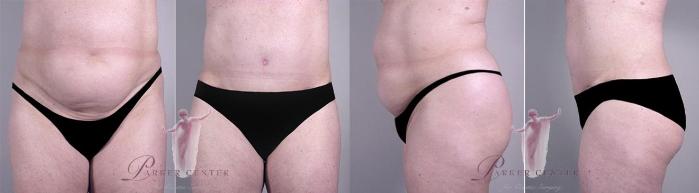 Tummy Tuck Case 1133 Before & After Front | Paramus, New Jersey | Parker Center for Plastic Surgery
