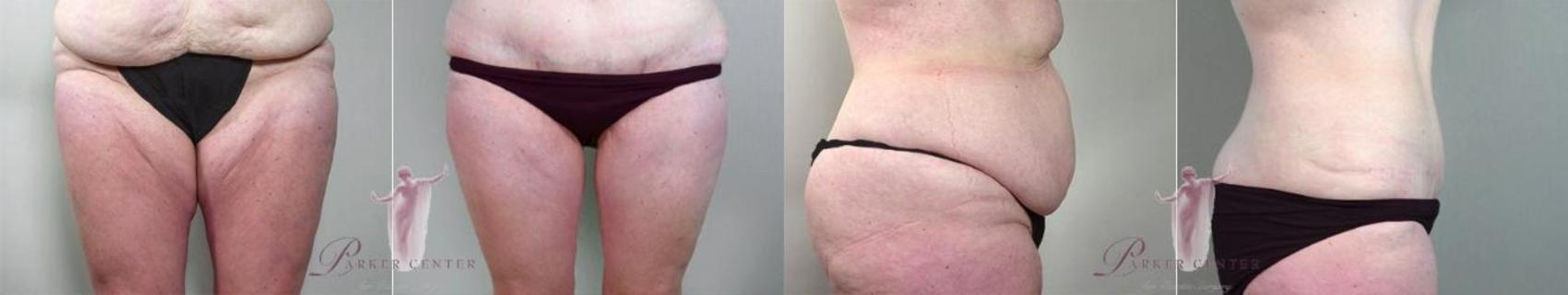 Tummy Tuck Case 1135 Before & After Front | Paramus, New Jersey | Parker Center for Plastic Surgery