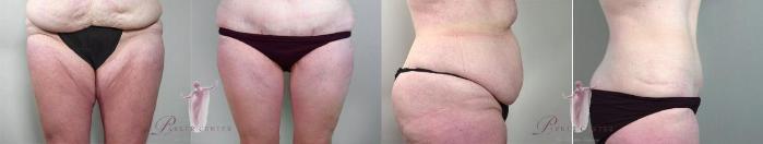 Tummy Tuck Case 1135 Before & After Front | Paramus, New Jersey | Parker Center for Plastic Surgery