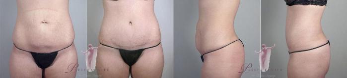 Tummy Tuck Case 1136 Before & After Front | Paramus, New Jersey | Parker Center for Plastic Surgery