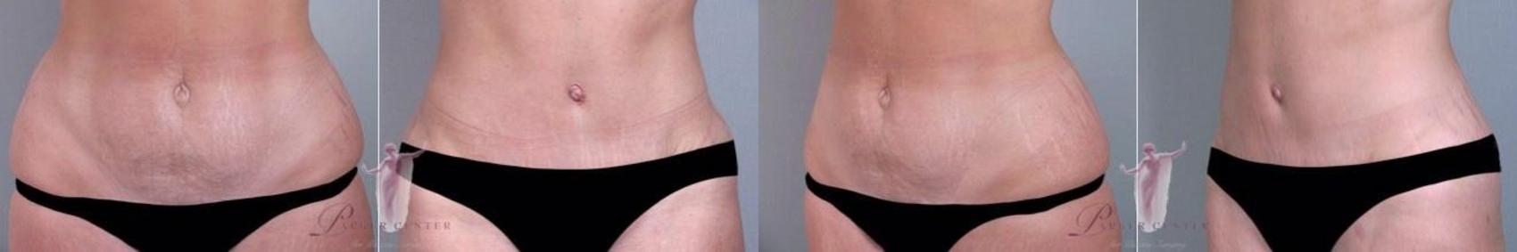 Tummy Tuck Case 1137 Before & After Front | Paramus, New Jersey | Parker Center for Plastic Surgery