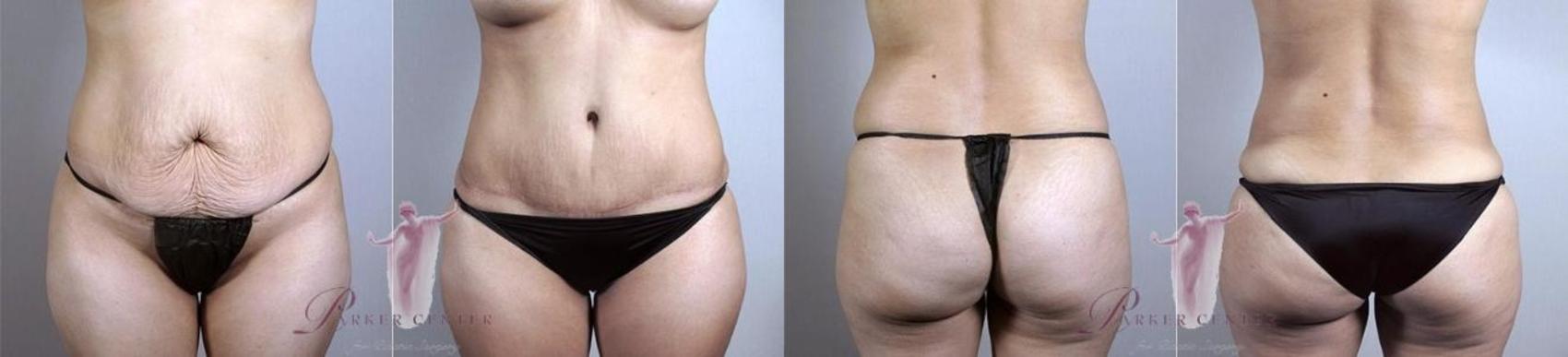 Tummy Tuck Case 1138 Before & After Front | Paramus, New Jersey | Parker Center for Plastic Surgery