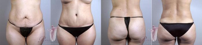 Tummy Tuck Case 1138 Before & After Front | Paramus, New Jersey | Parker Center for Plastic Surgery