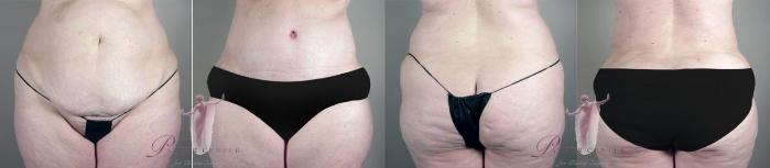 Tummy Tuck Case 1139 Before & After Front | Paramus, New Jersey | Parker Center for Plastic Surgery