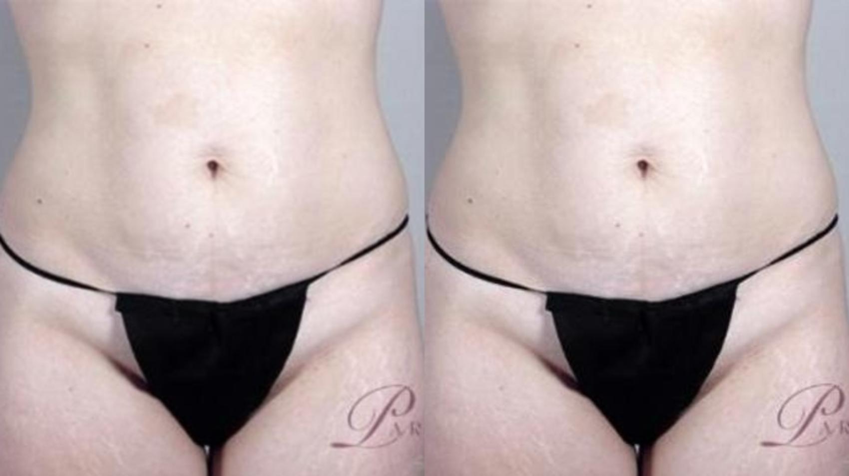 Tummy Tuck Case 1140 Before & After Front | Paramus, New Jersey | Parker Center for Plastic Surgery