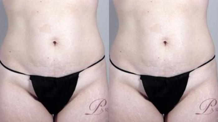 Tummy Tuck Case 1140 Before & After Front | Paramus, New Jersey | Parker Center for Plastic Surgery