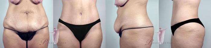 Liposuction Case 1141 Before & After Front | Paramus, New Jersey | Parker Center for Plastic Surgery