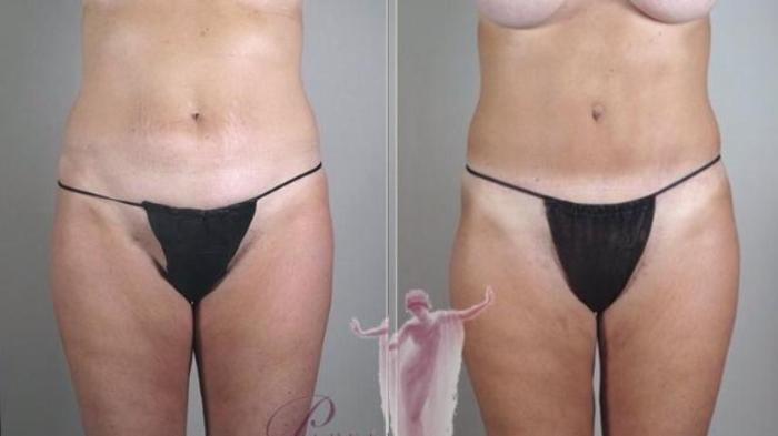 Tummy Tuck Case 1143 Before & After Front | Paramus, New Jersey | Parker Center for Plastic Surgery
