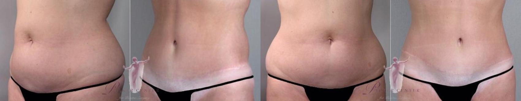 Tummy Tuck Case 1144 Before & After Front | Paramus, New Jersey | Parker Center for Plastic Surgery