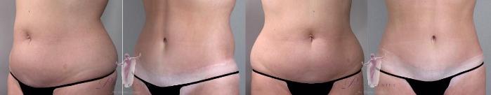 Tummy Tuck Case 1144 Before & After Front | Paramus, New Jersey | Parker Center for Plastic Surgery