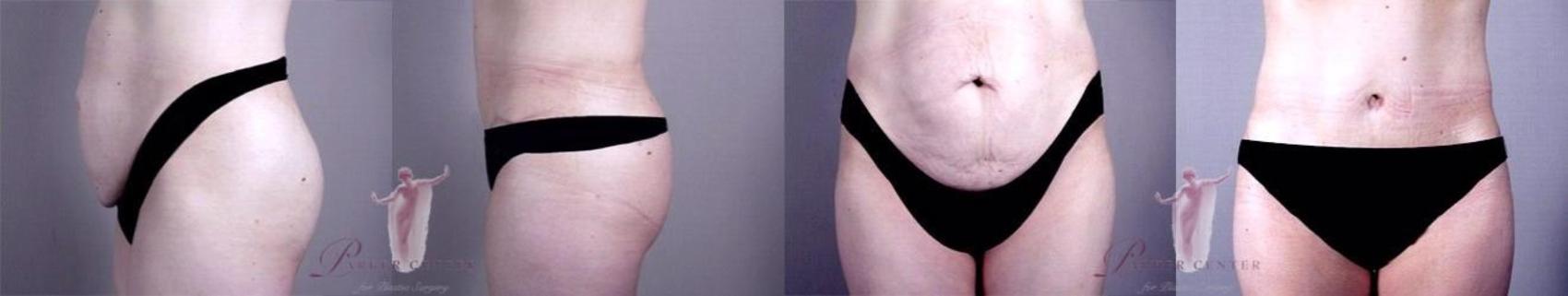 Tummy Tuck Case 1145 Before & After Front | Paramus, New Jersey | Parker Center for Plastic Surgery