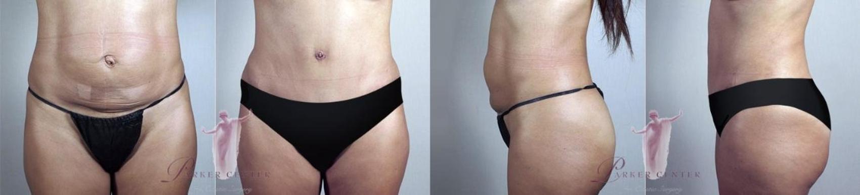 Tummy Tuck Case 1146 Before & After Front | Paramus, New Jersey | Parker Center for Plastic Surgery