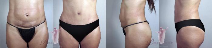 Tummy Tuck Case 1146 Before & After Front | Paramus, New Jersey | Parker Center for Plastic Surgery