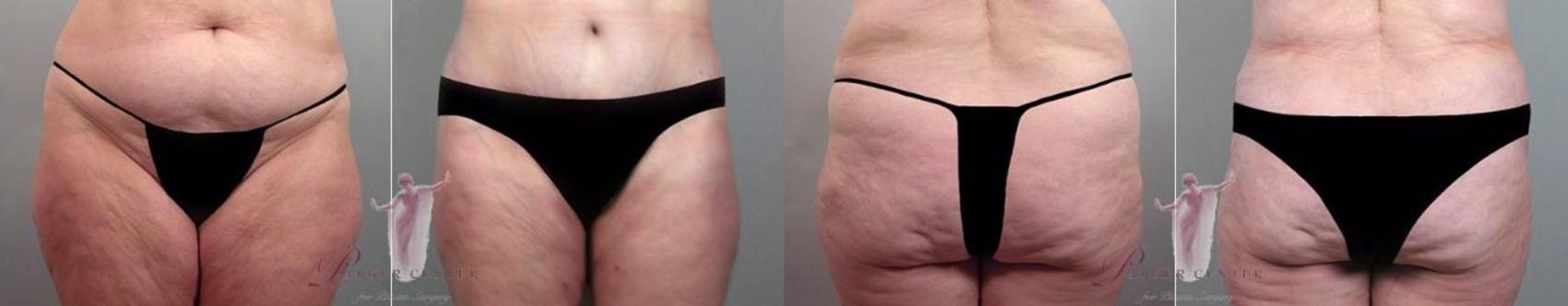 Liposuction Case 1147 Before & After Front | Paramus, New Jersey | Parker Center for Plastic Surgery