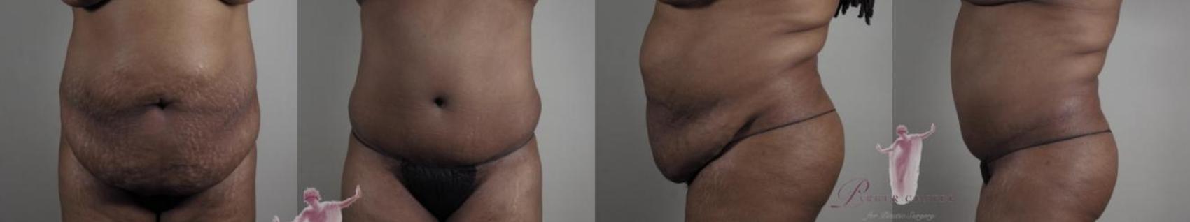 Tummy Tuck Case 1150 Before & After Front | Paramus, New Jersey | Parker Center for Plastic Surgery