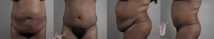 Tummy Tuck Case 1150 Before & After Front | Paramus, New Jersey | Parker Center for Plastic Surgery