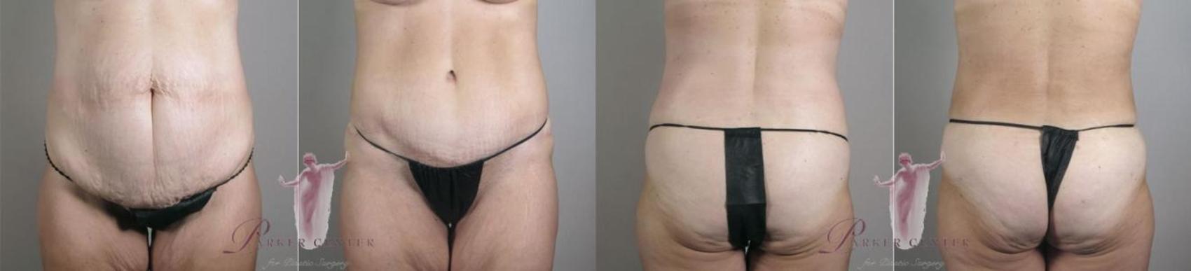 Tummy Tuck Case 1151 Before & After Front | Paramus, New Jersey | Parker Center for Plastic Surgery