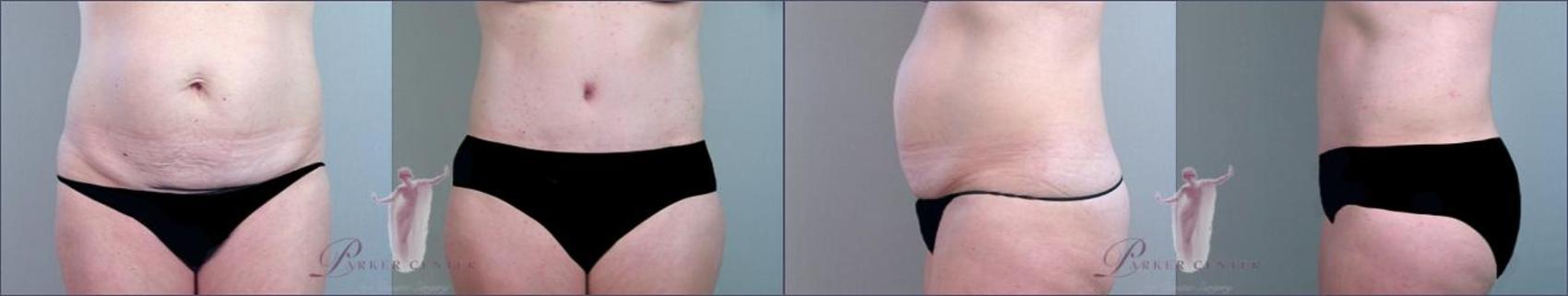 Tummy Tuck Case 1153 Before & After Front | Paramus, New Jersey | Parker Center for Plastic Surgery