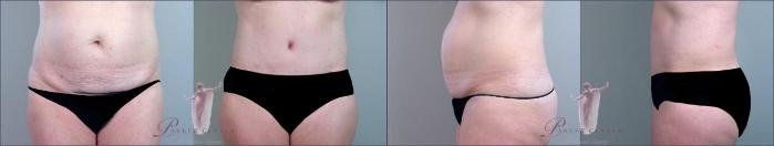 Tummy Tuck Case 1153 Before & After Front | Paramus, New Jersey | Parker Center for Plastic Surgery