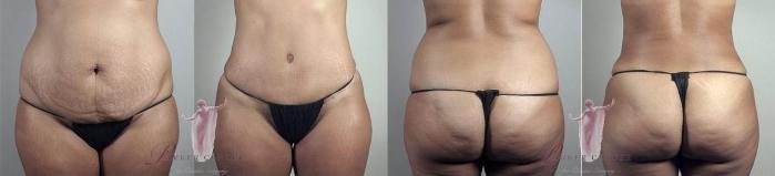Tummy Tuck Case 1158 Before & After Front | Paramus, New Jersey | Parker Center for Plastic Surgery