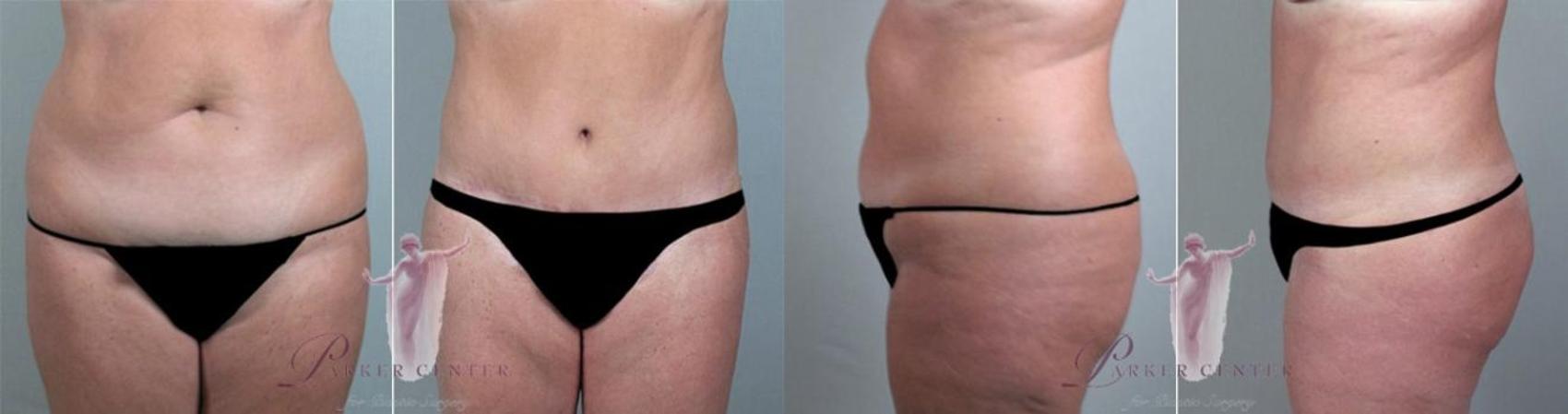 Tummy Tuck Case 1159 Before & After Front | Paramus, New Jersey | Parker Center for Plastic Surgery