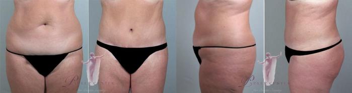 Tummy Tuck Case 1159 Before & After Front | Paramus, New Jersey | Parker Center for Plastic Surgery