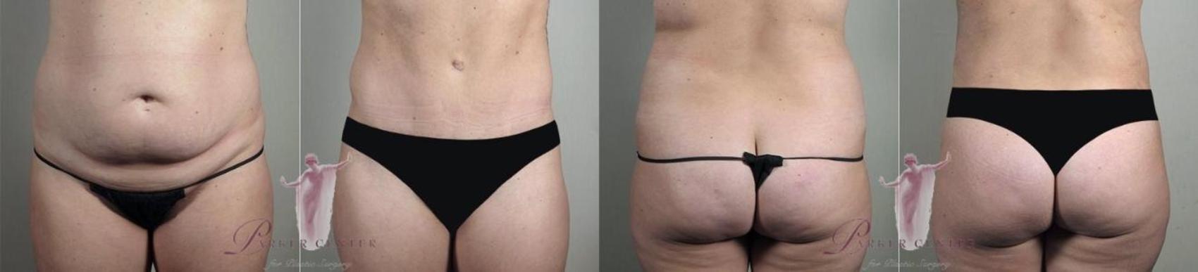 Tummy Tuck Case 1160 Before & After Front | Paramus, New Jersey | Parker Center for Plastic Surgery