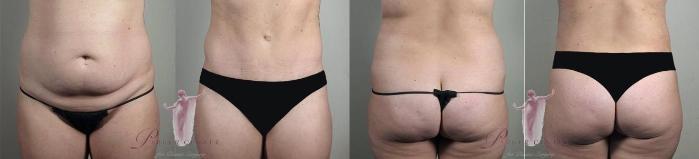 Tummy Tuck Case 1160 Before & After Front | Paramus, New Jersey | Parker Center for Plastic Surgery