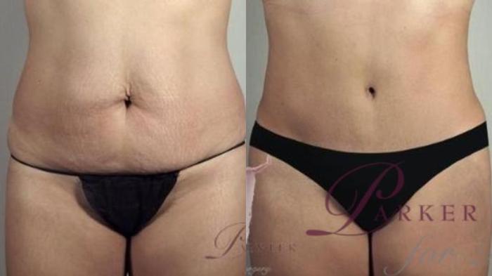 Tummy Tuck Case 1164 Before & After Front | Paramus, New Jersey | Parker Center for Plastic Surgery
