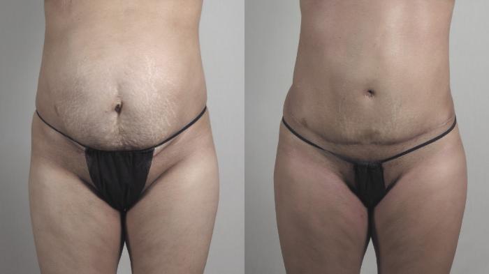 Tummy Tuck Case 1221 Before & After View #1  | Paramus, New Jersey | Parker Center for Plastic Surgery