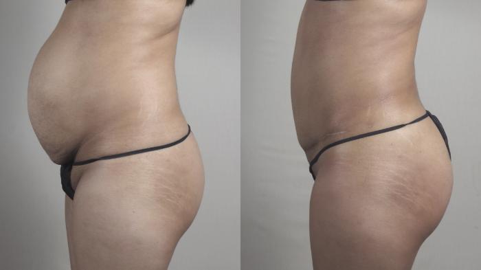 Tummy Tuck Case 1221 Before & After View #2 | Paramus, New Jersey | Parker Center for Plastic Surgery