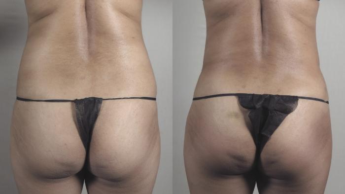 Tummy Tuck Case 1221 Before & After View #3 | Paramus, New Jersey | Parker Center for Plastic Surgery