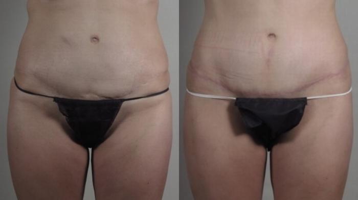 Tummy Tuck Case 1238 Before & After Front | Paramus, New Jersey | Parker Center for Plastic Surgery