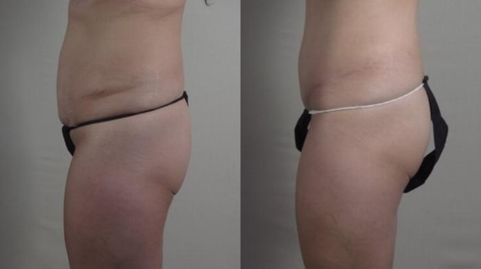 Tummy Tuck Case 1238 Before & After Left Side | Paramus, New Jersey | Parker Center for Plastic Surgery