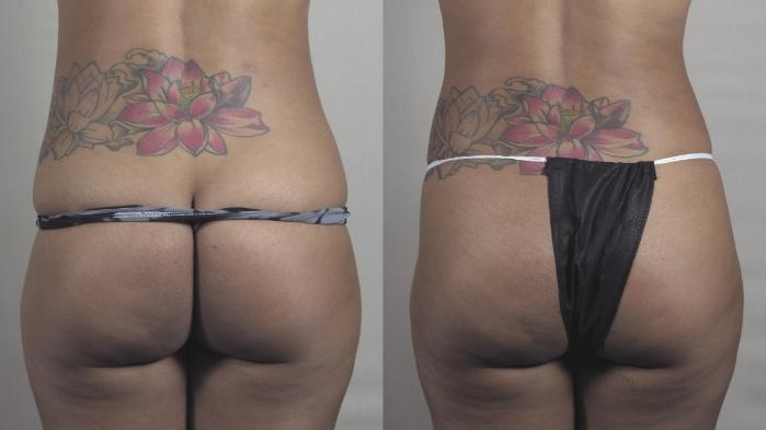 Liposuction Case 1300 Before & After Back | Paramus, New Jersey | Parker Center for Plastic Surgery