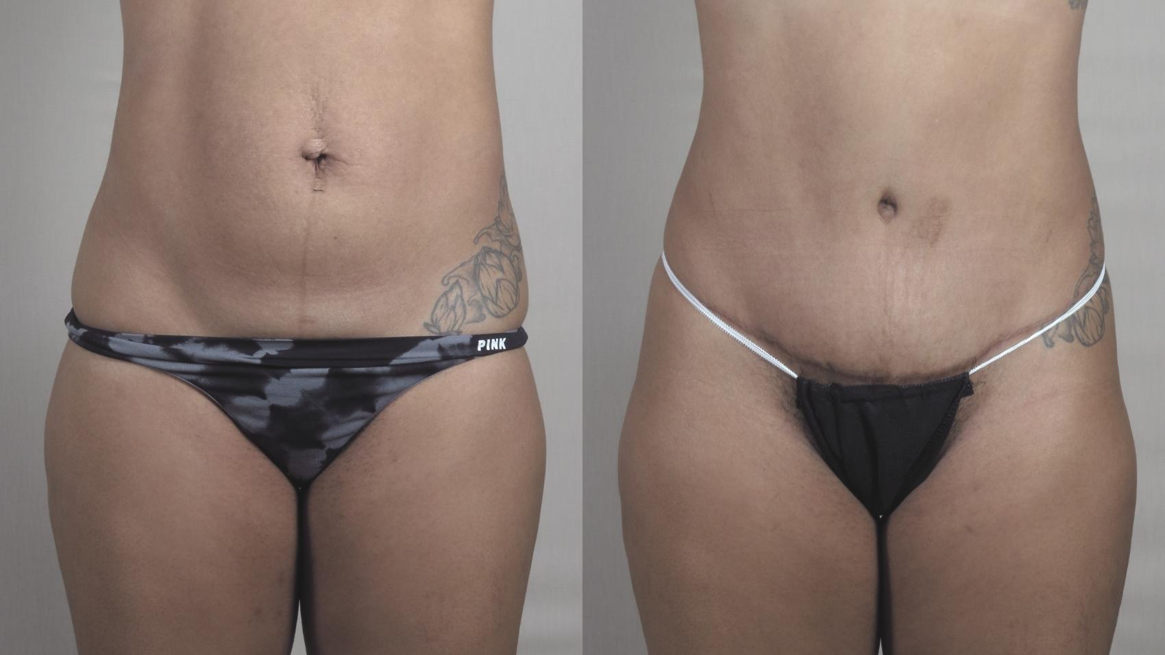 Liposuction Case 1300 Before & After Front | Paramus, New Jersey | Parker Center for Plastic Surgery