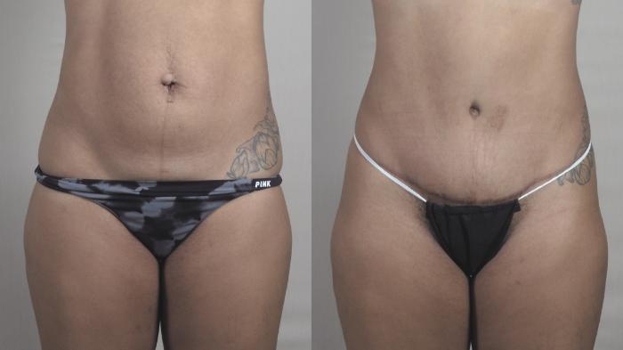 Liposuction Case 1300 Before & After Front | Paramus, New Jersey | Parker Center for Plastic Surgery