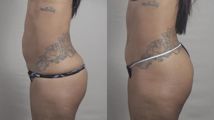 Liposuction Case 1300 Before & After Left Side | Paramus, New Jersey | Parker Center for Plastic Surgery