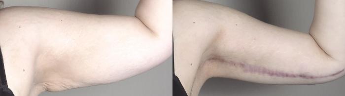 Liposuction Case 1317 Before & After arms | Paramus, New Jersey | Parker Center for Plastic Surgery