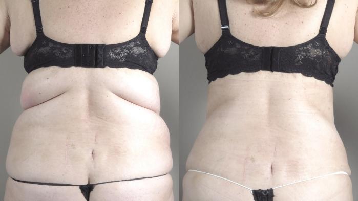 Liposuction Case 1317 Before & After back  | Paramus, New Jersey | Parker Center for Plastic Surgery
