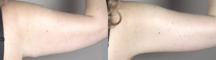 Liposuction Case 1317 Before & After back | Paramus, New Jersey | Parker Center for Plastic Surgery