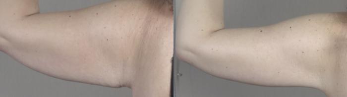 Liposuction Case 1317 Before & After back1 | Paramus, New Jersey | Parker Center for Plastic Surgery