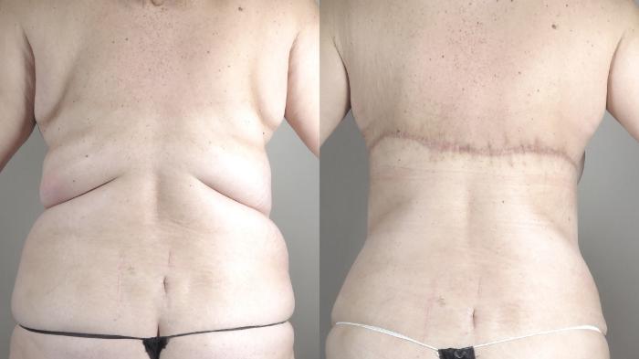 Liposuction Case 1317 Before & After bra line | Paramus, New Jersey | Parker Center for Plastic Surgery