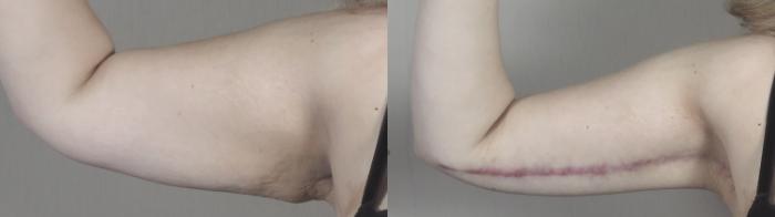Liposuction Case 1317 Before & After front  | Paramus, New Jersey | Parker Center for Plastic Surgery