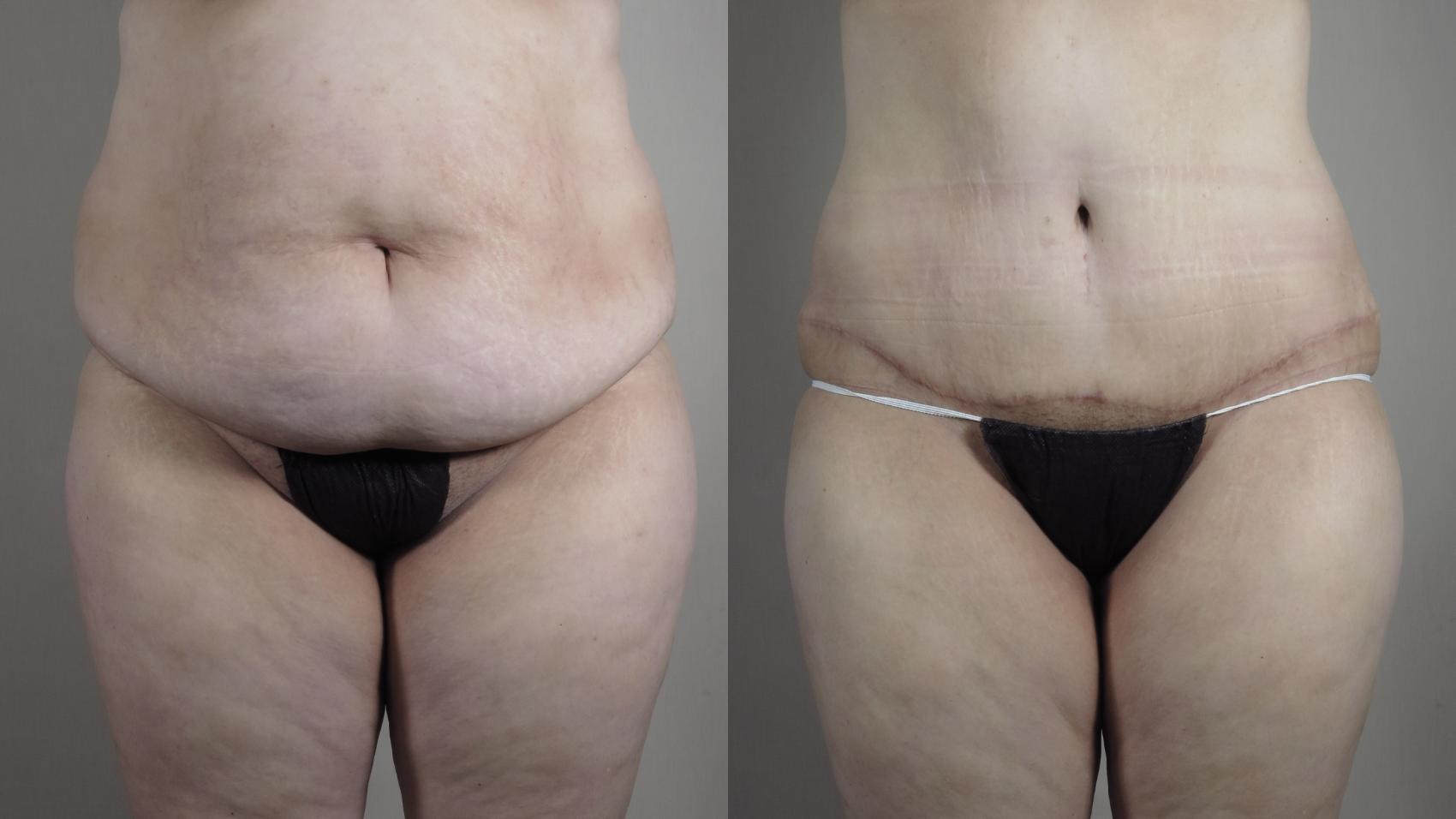 Liposuction Case 1317 Before & After Front | Paramus, New Jersey | Parker Center for Plastic Surgery