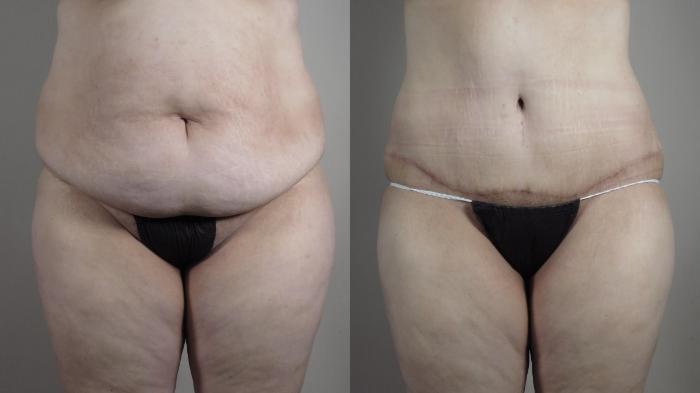 Liposuction Case 1317 Before & After Front | Paramus, New Jersey | Parker Center for Plastic Surgery