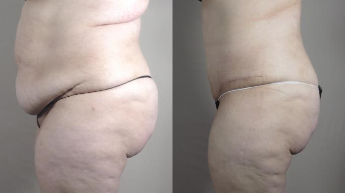 Liposuction Case 1317 Before & After Left Side | Paramus, New Jersey | Parker Center for Plastic Surgery