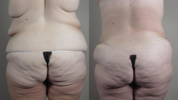 Tummy Tuck Case 1319 Before & After Back | Paramus, New Jersey | Parker Center for Plastic Surgery