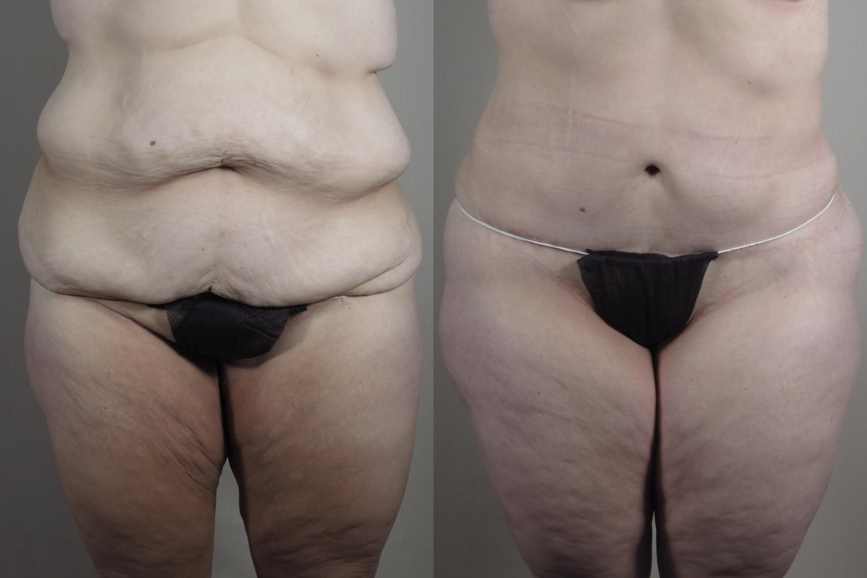Tummy Tuck Case 1319 Before & After Front | Paramus, New Jersey | Parker Center for Plastic Surgery